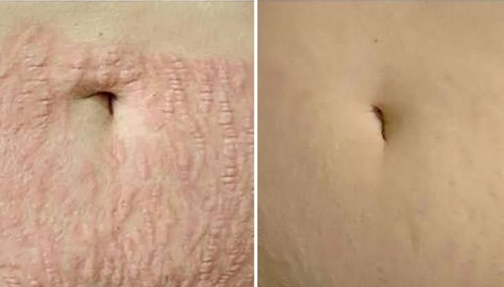 Antes e depois de estrias no abdômen