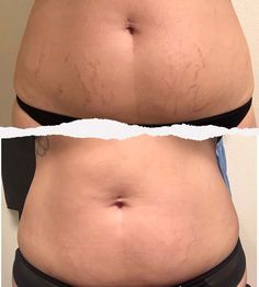 Antes e depois de estrias na barriga