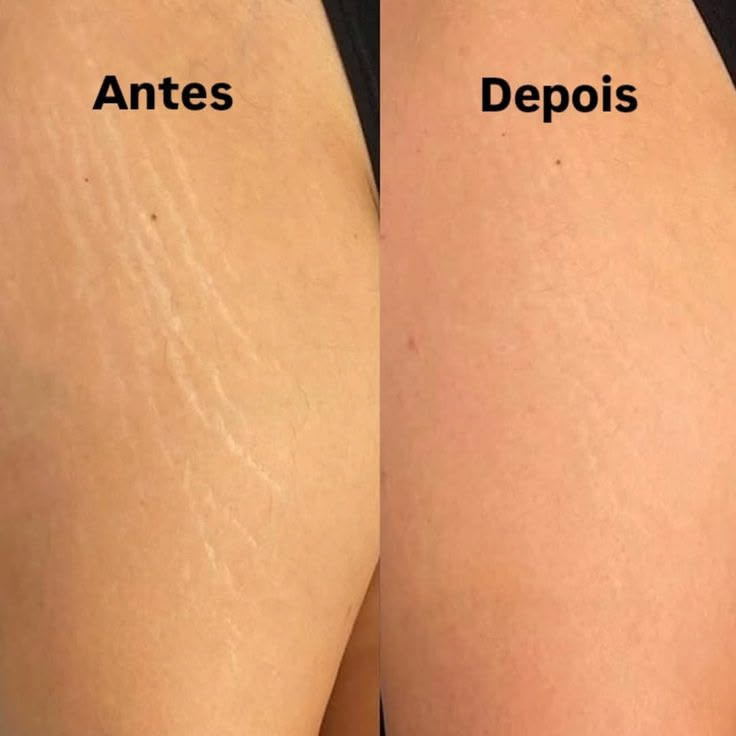 Antes e depois de estrias na coxa