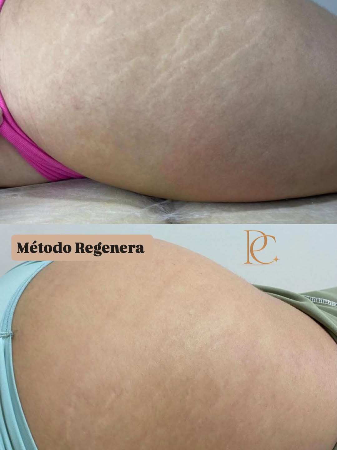 Antes e depois de tratamento de estrias — Método Regenera, Pamella Cinque
